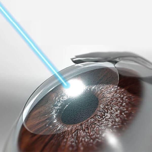 Lasers Retina surgery 