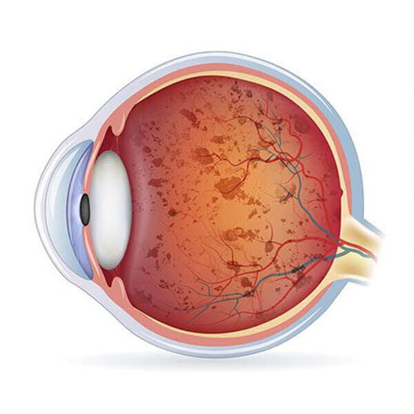 retinitis pigmentosa
                    treatment