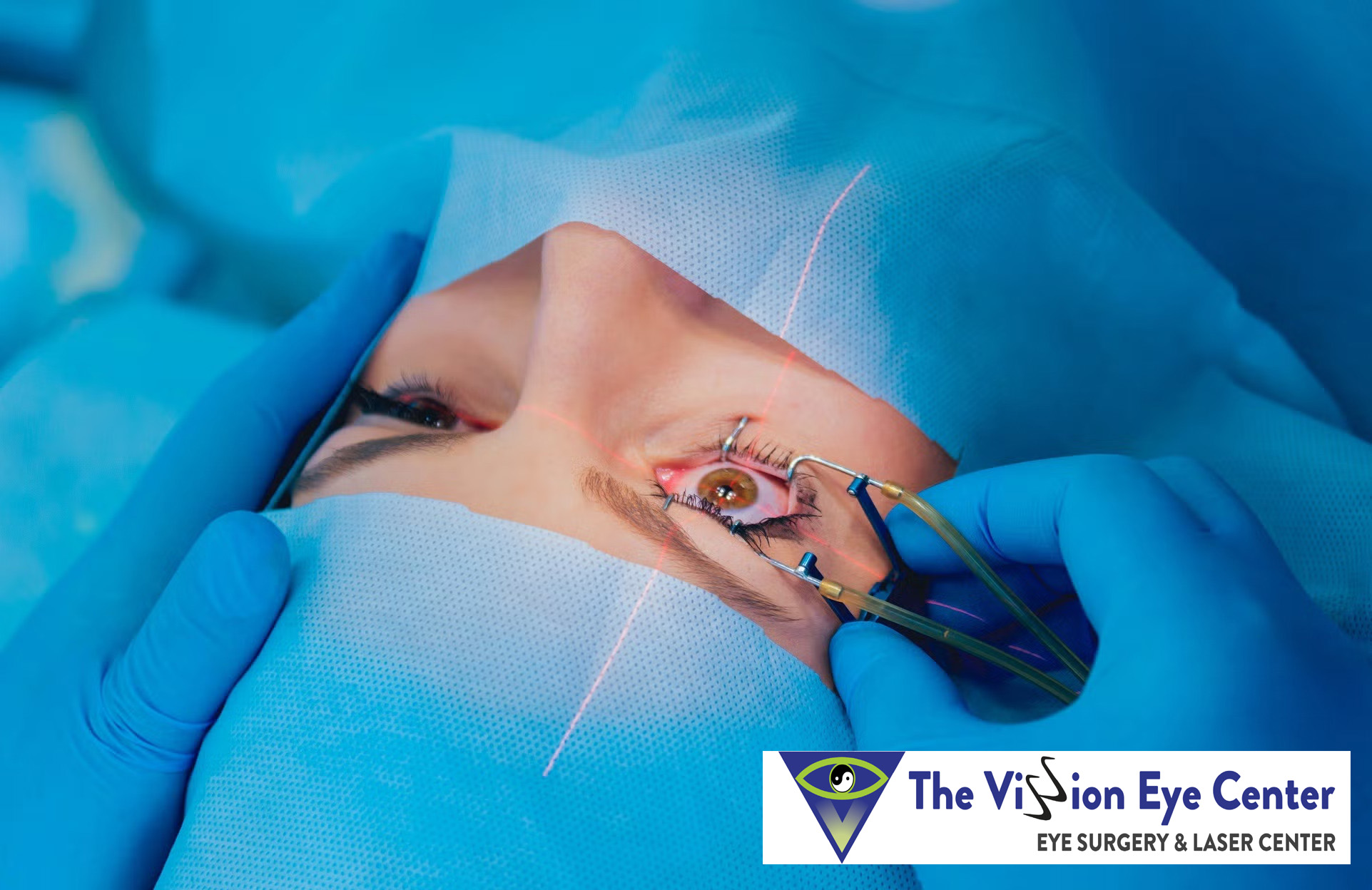 Lasik Eye Surgery