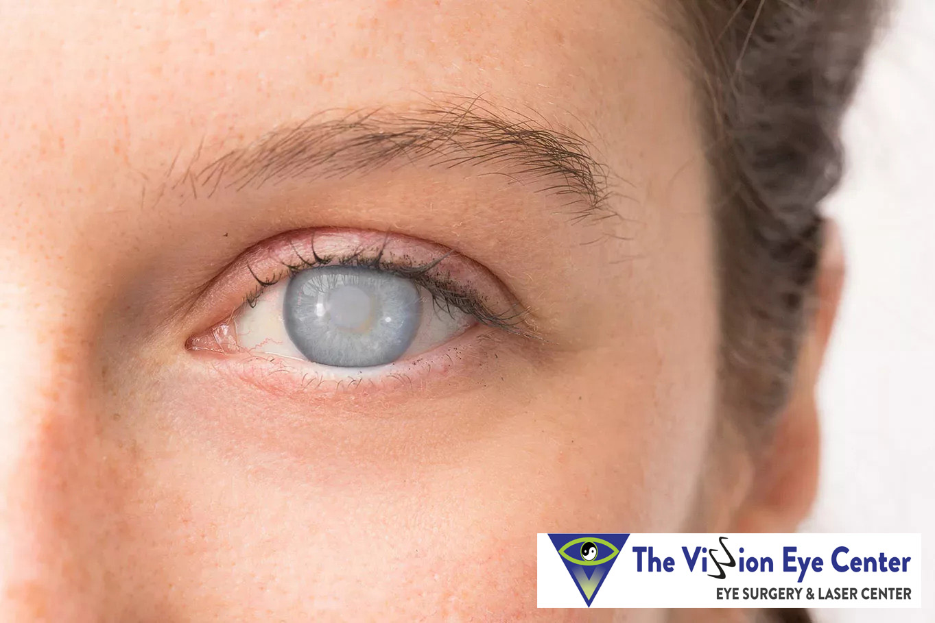cataract surgery 