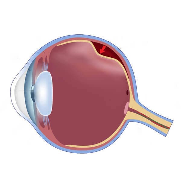 Retina Specialist - Retinal Detachment