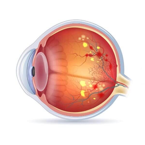 Retina Specialist - Diabetic Retinopathy