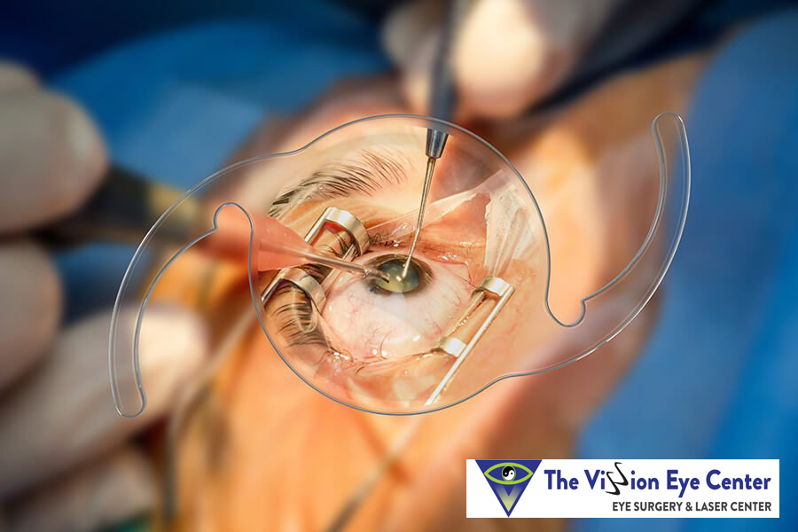 Lasik Eye Surgery